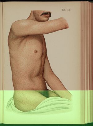 Tab 13, Roseola, male torso, Mracek, 1898 Wellcome L0074267.jpg
